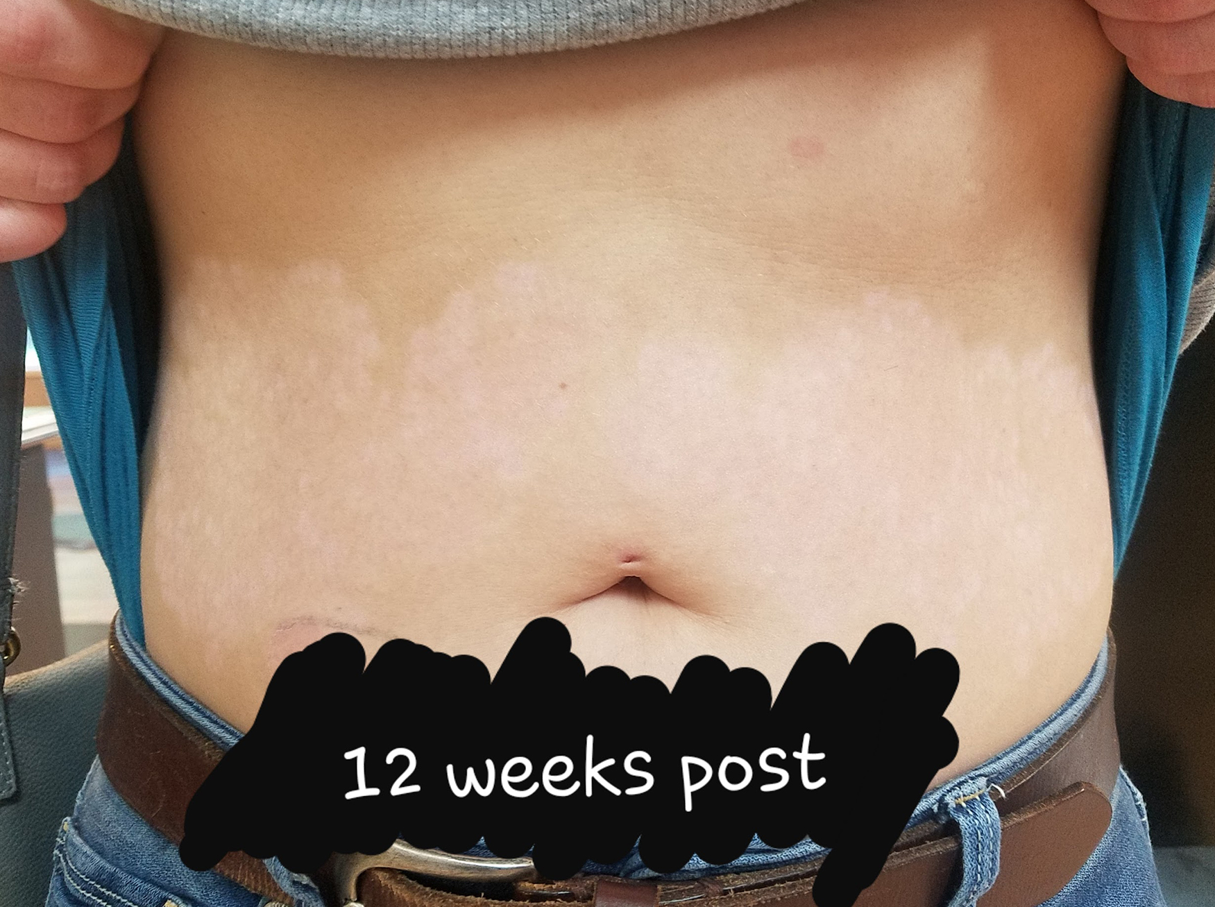 12 weeks of the persons stomach after sugaring