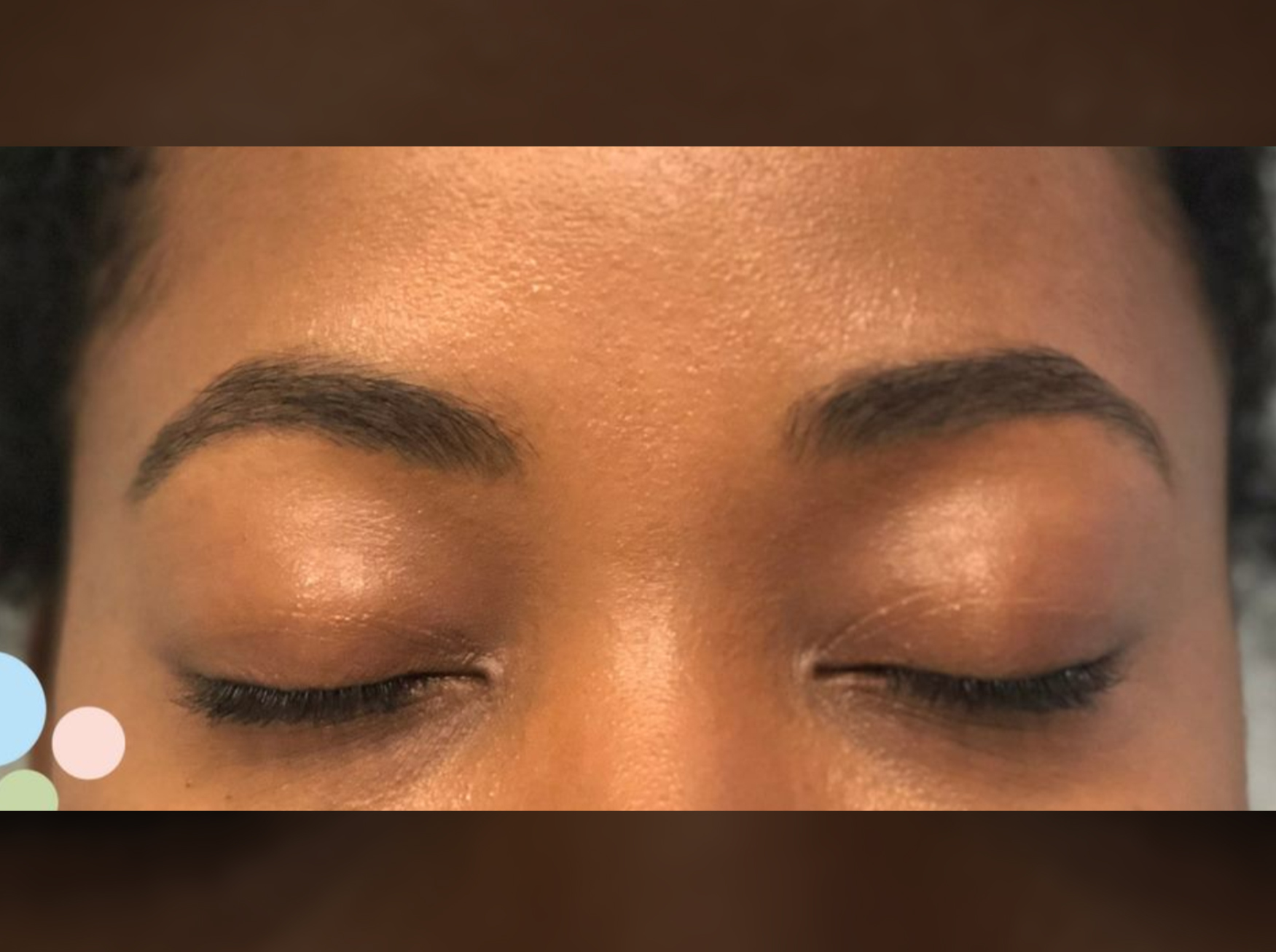 A persons brow ridge After Sugaring