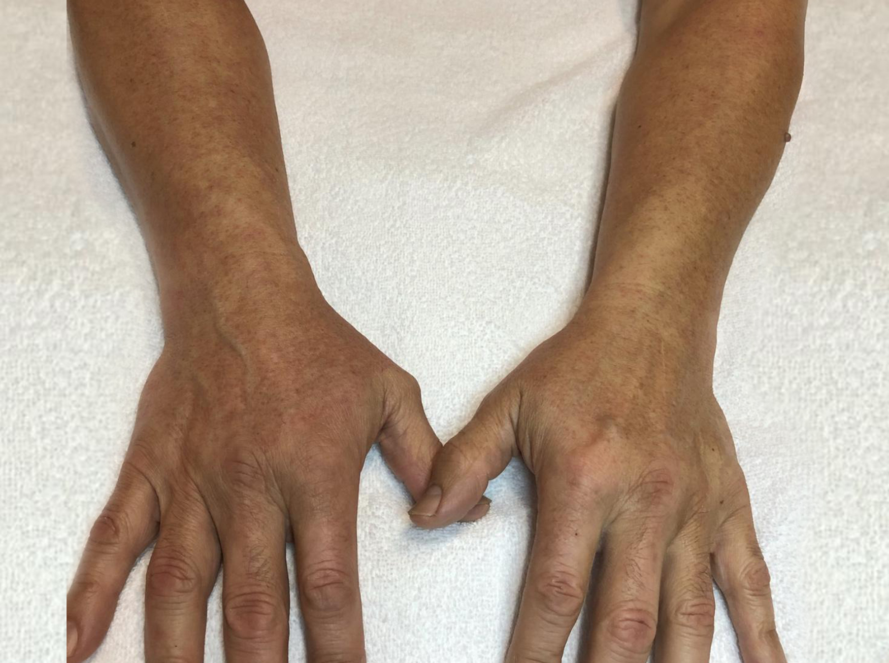 A mans arms after sugaring
